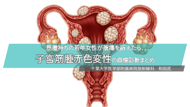 筋腫持ちの若年女性が腹痛を訴えたら．．．子宮筋腫赤色変性の画像診断まとめ