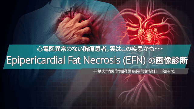 心電図異常のない胸痛患者，実はこの疾患かも・・・ Epipericardial Fat Necrosis (EFN) の画像診断