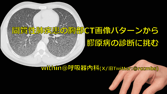 間質性肺疾患の胸部CT画像パターンから  膠原病の診断に挑む