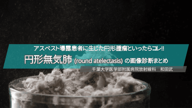 アスベスト曝露患者に生じた円形腫瘤といったらコレ!! 円形無気肺 (round atelectasis) の画像診断まとめ