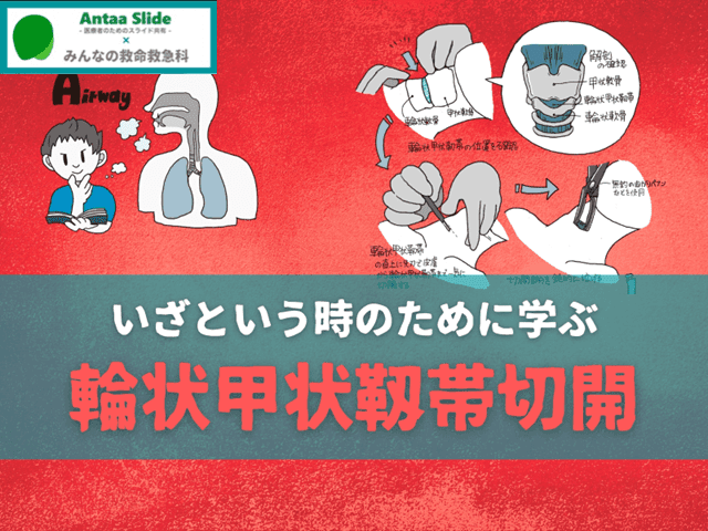 【いざという時のために学ぶ】輪状甲状靱帯切開のまとめ