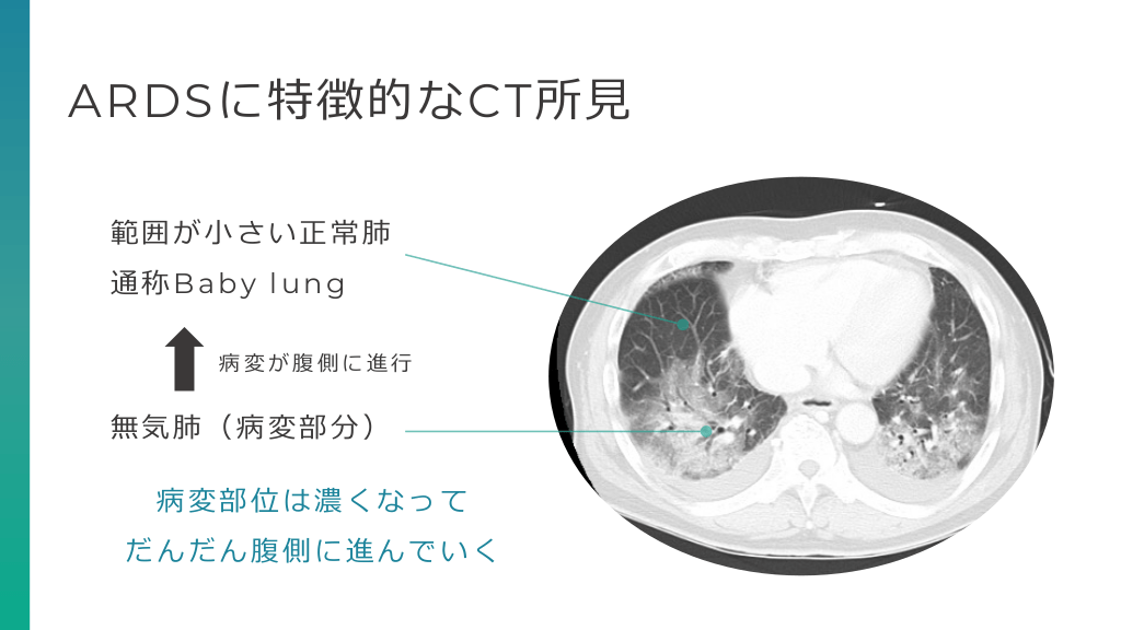 ARDS STANDARD CARE ARDS患者を悪くしないためになにをしたらいいのか？ | Antaa Slide