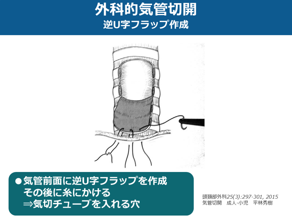 輪状甲状切開術と気管切開術の有効性