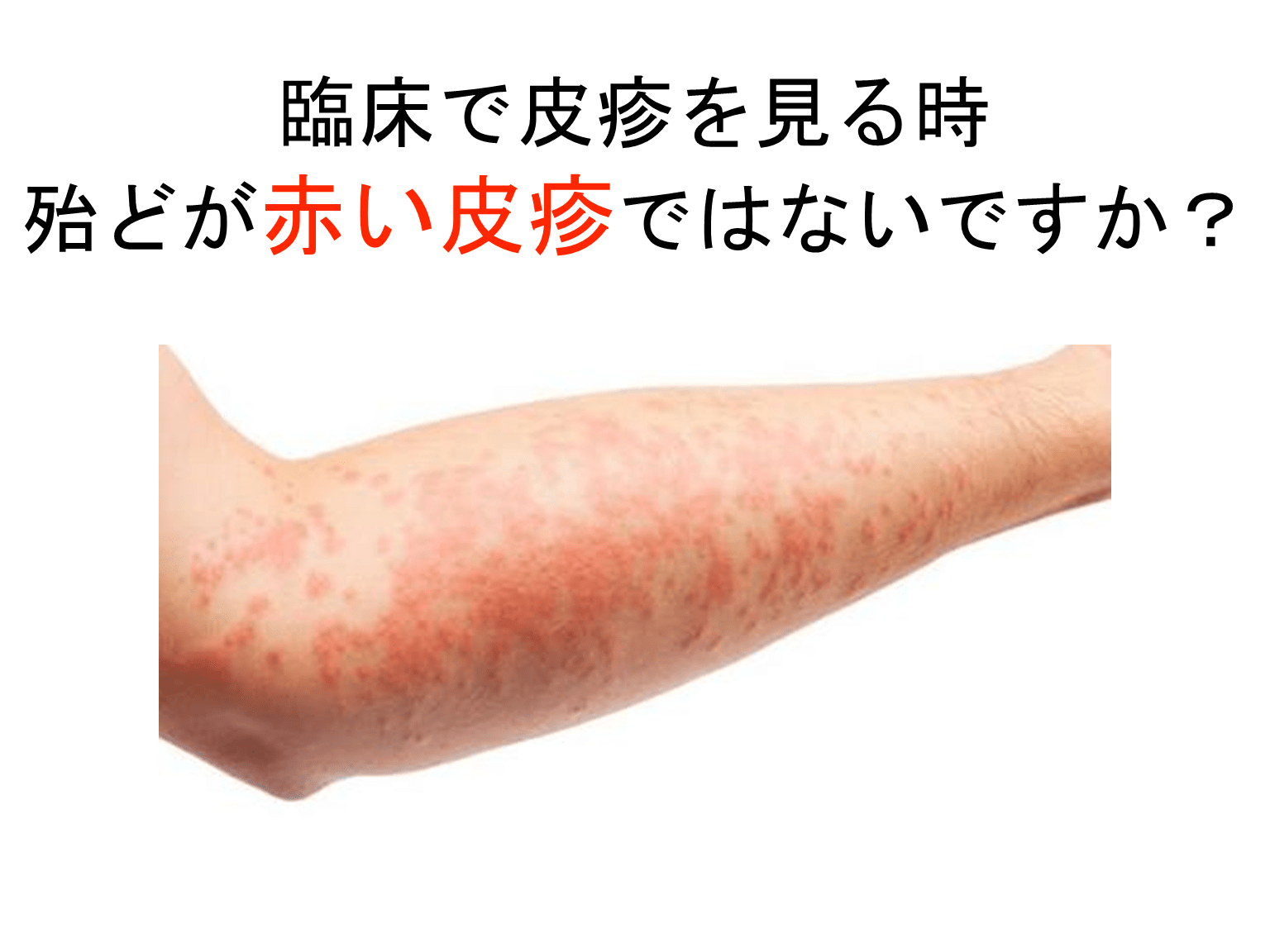 発疹種類表 | 皮膚 発疹 画像 – ONMT