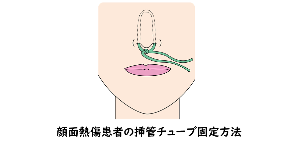 顔面熱傷患者の挿管チューブ固定 L001.png