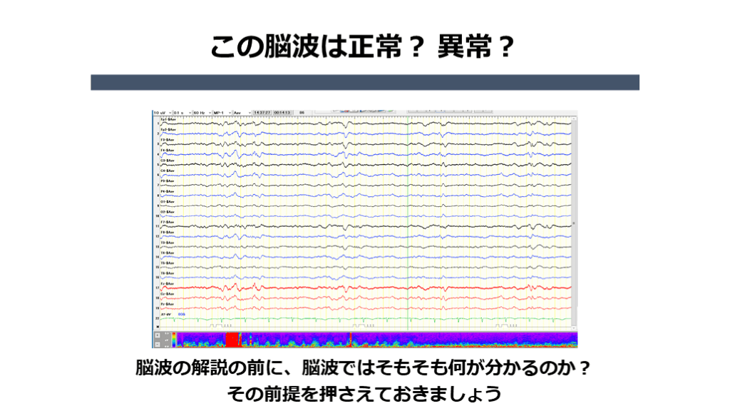 脳波 レジデントが押さえておきたい2つのPOINT | Antaa Slide