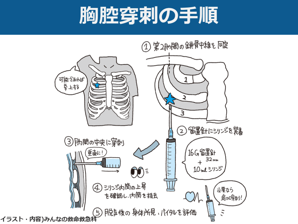 【いざという時のために学ぶ】胸腔穿刺・胸腔ドレーンのまとめ | Antaa Slide