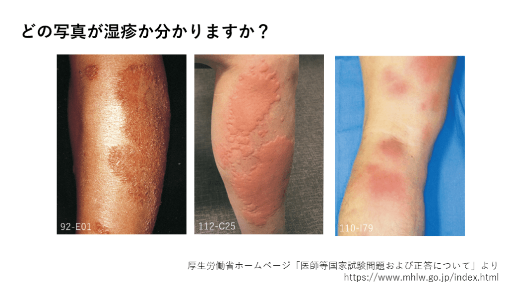 プライマリ・ケアのための皮疹診断のポイント | Antaa Slide プライマリ・ケアのための皮疹診断のポイント | Antaa Slide
