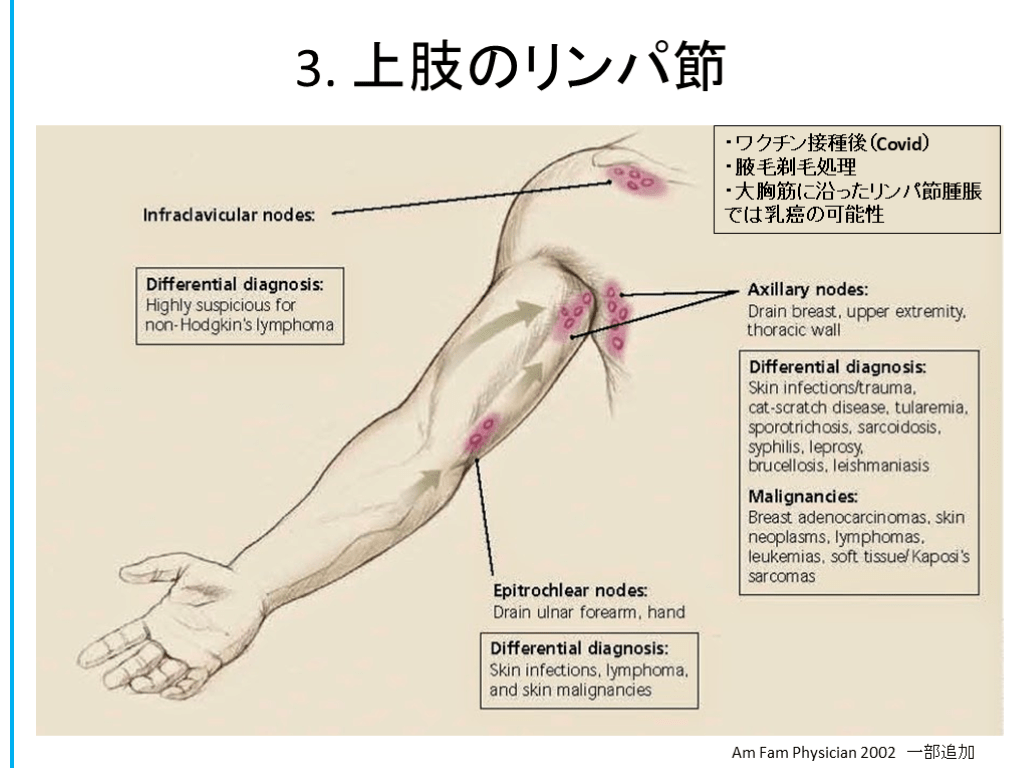 リンパ 節腫脹鑑別: リンパ腫脹 主な鑑別疾患 – FTJVY