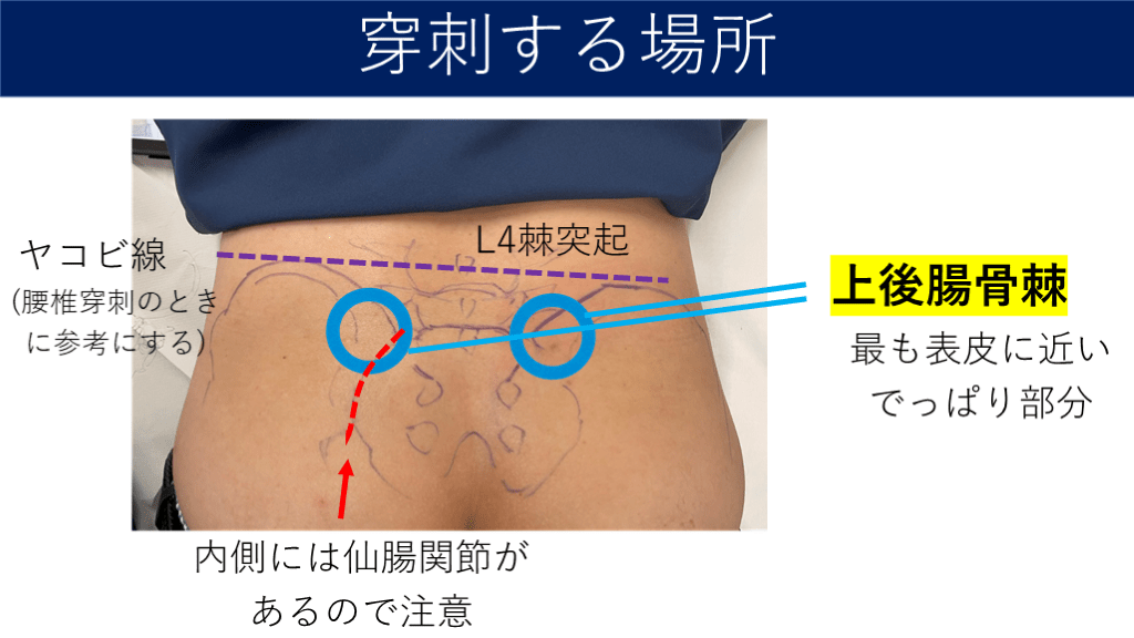コツを覚えて必ずできる!体腔穿刺―部位・臓器別にみる間違いのない穿刺のポイント (ビジュアル基本手技 8) コツを覚えて必ずできる!体腔穿刺―部位・臓器別にみる間違いの