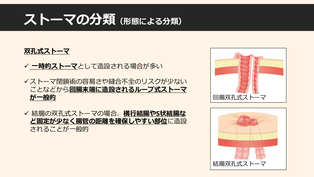 肛門がん手術からの回復