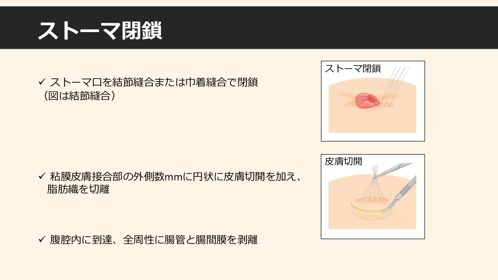 人工肛門のある生活