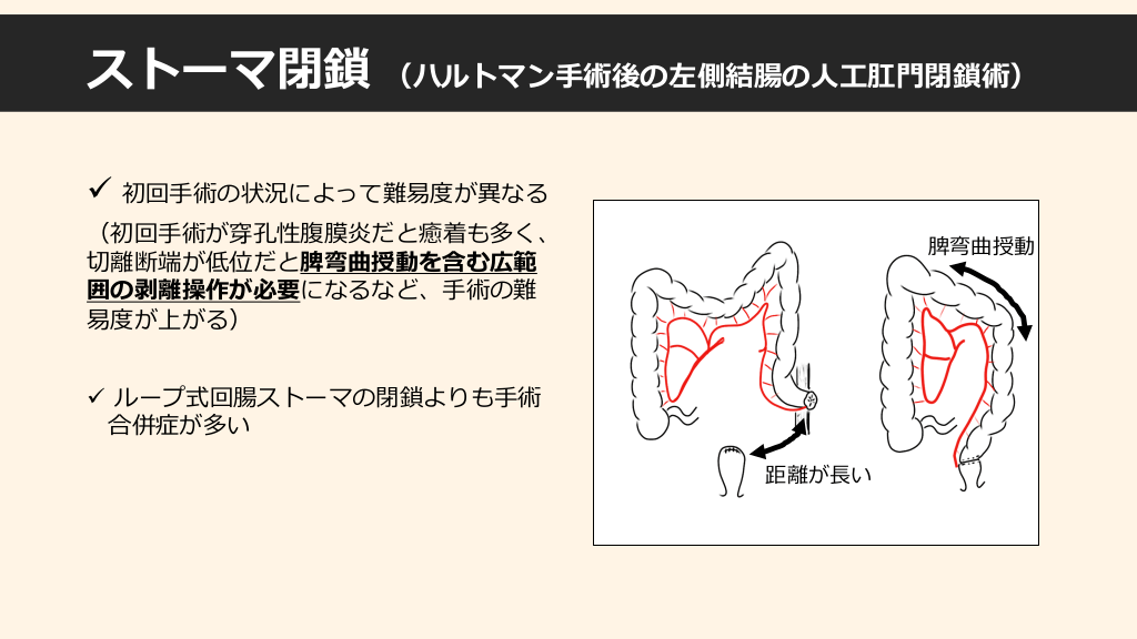 人工肛門形成術のリスク