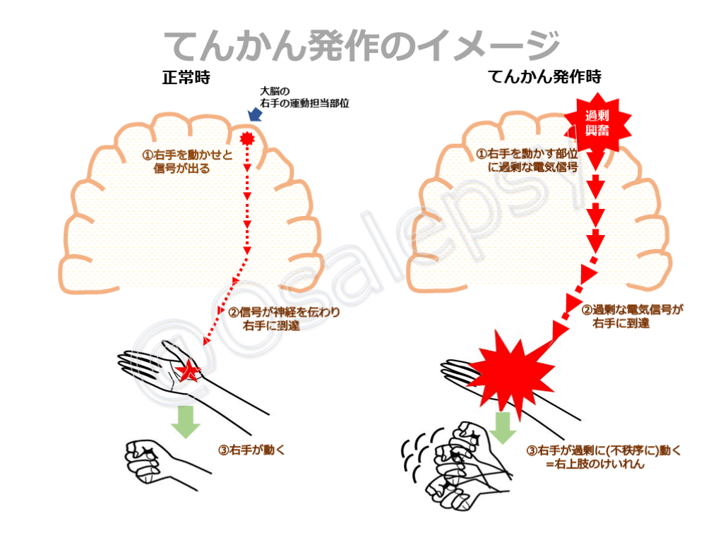 熱性発作(熱性けいれん)について ~対応と注意すべき疾患・てんかん症候群も含めて~ | Antaa Slide