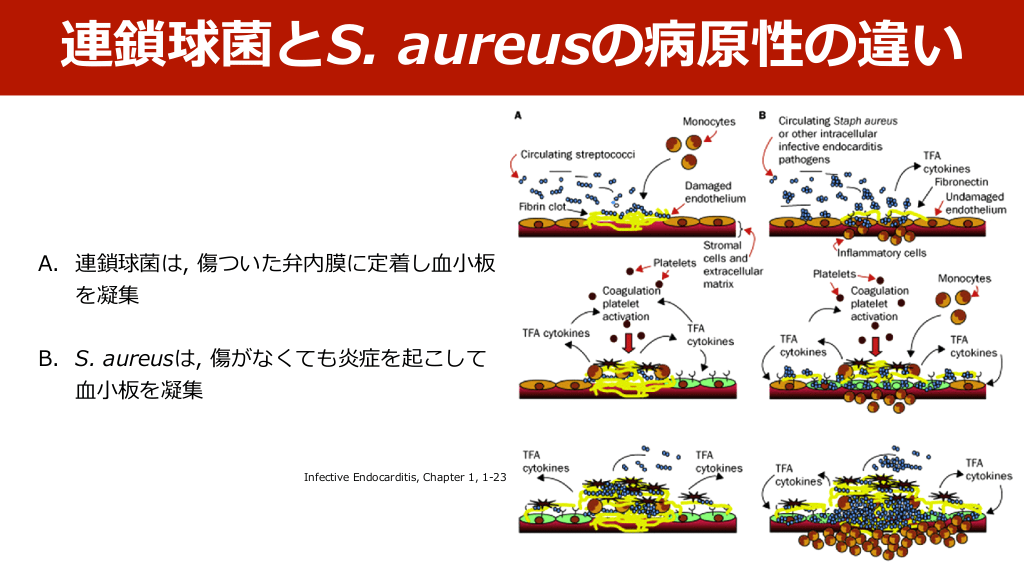 感染性心内膜炎の1例 – 感染症心内膜炎による脳出血 , 第206回東北地方会-第2会場 – YGNAVP