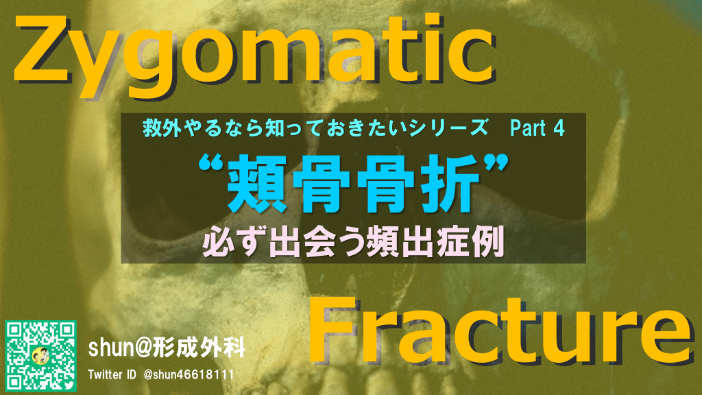 頬骨骨折 必ず出会う頻出症例 救外やるなら知っておきたいシリーズpart 4 Antaa Slide 頬骨骨折 必ず出会う頻出症例 救外やるなら知っておきたいシリーズpart 4 Antaa Slide