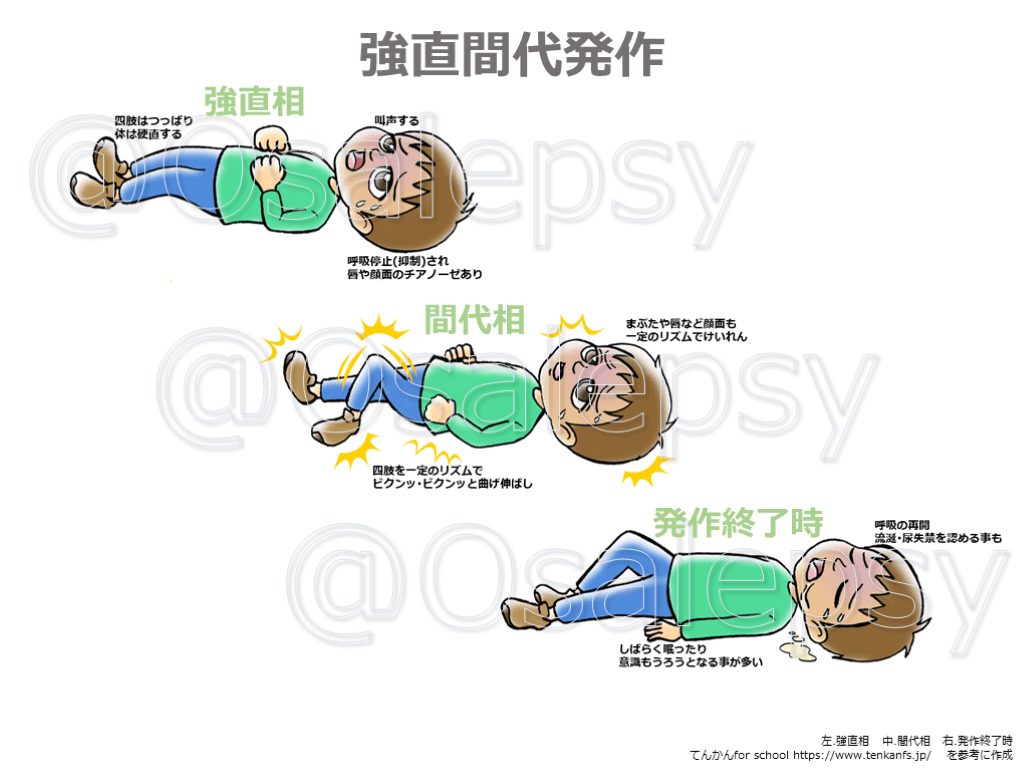 説明にそのまま使える 病院外におけるけいれん・てんかん発作に出くわした際の対処法 | Antaa Slide