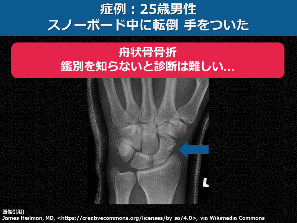 【症例で学ぶ!】+αの外傷診療【手をついた FOOSH injury】 | Antaa Slide