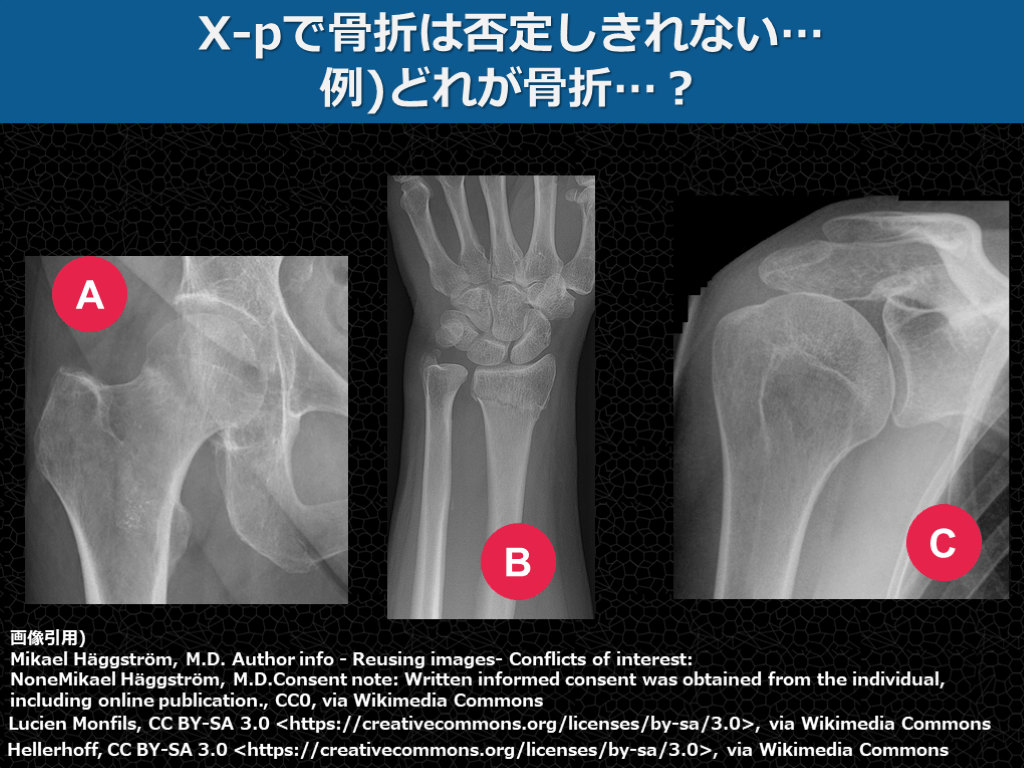 【症例で学ぶ!】+αの外傷診療【手をついた FOOSH injury】 | Antaa Slide