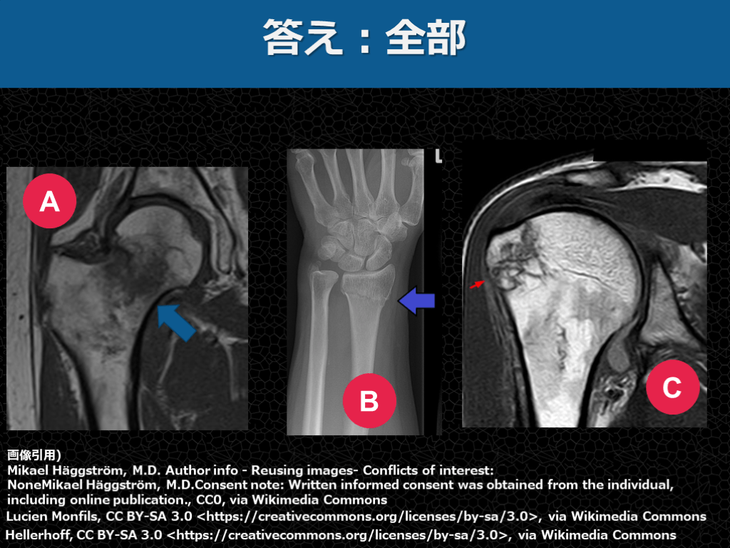 【症例で学ぶ!】+αの外傷診療【手をついた FOOSH injury】 | Antaa Slide