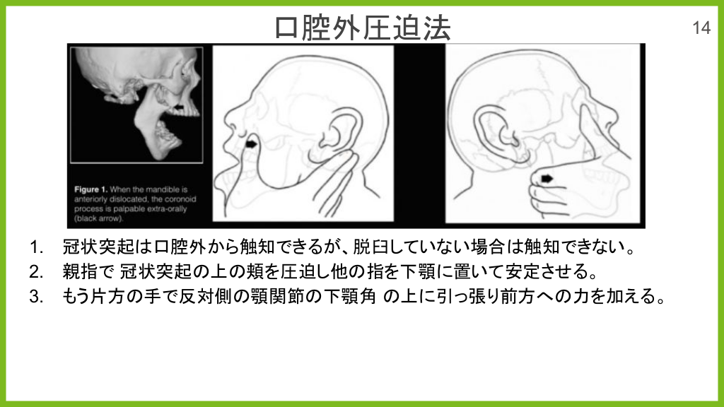 5分でわかる 10秒で治せる あご 脱臼整復 | Antaa Slide
