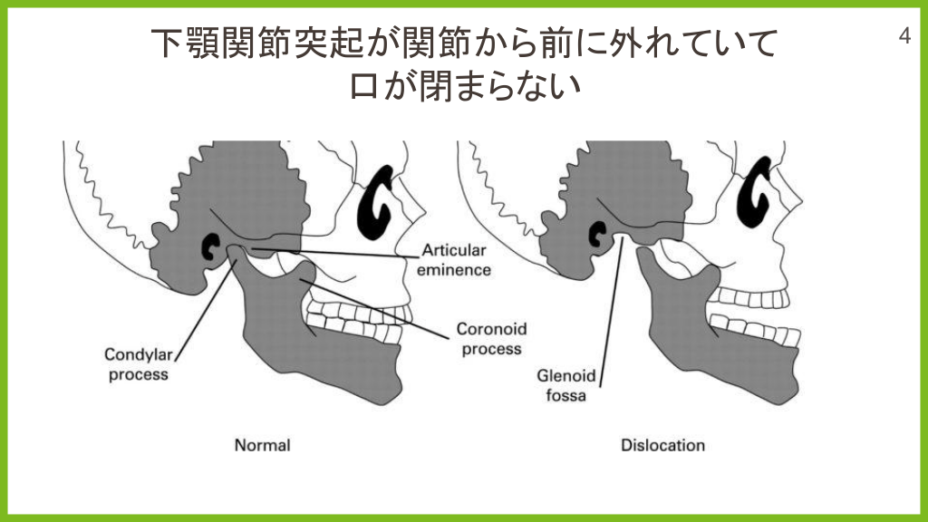 5分でわかる 10秒で治せる あご 脱臼整復 | Antaa Slide