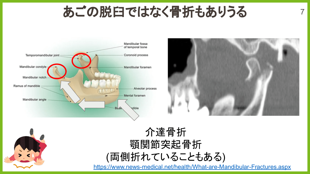 5分でわかる 10秒で治せる あご 脱臼整復 | Antaa Slide