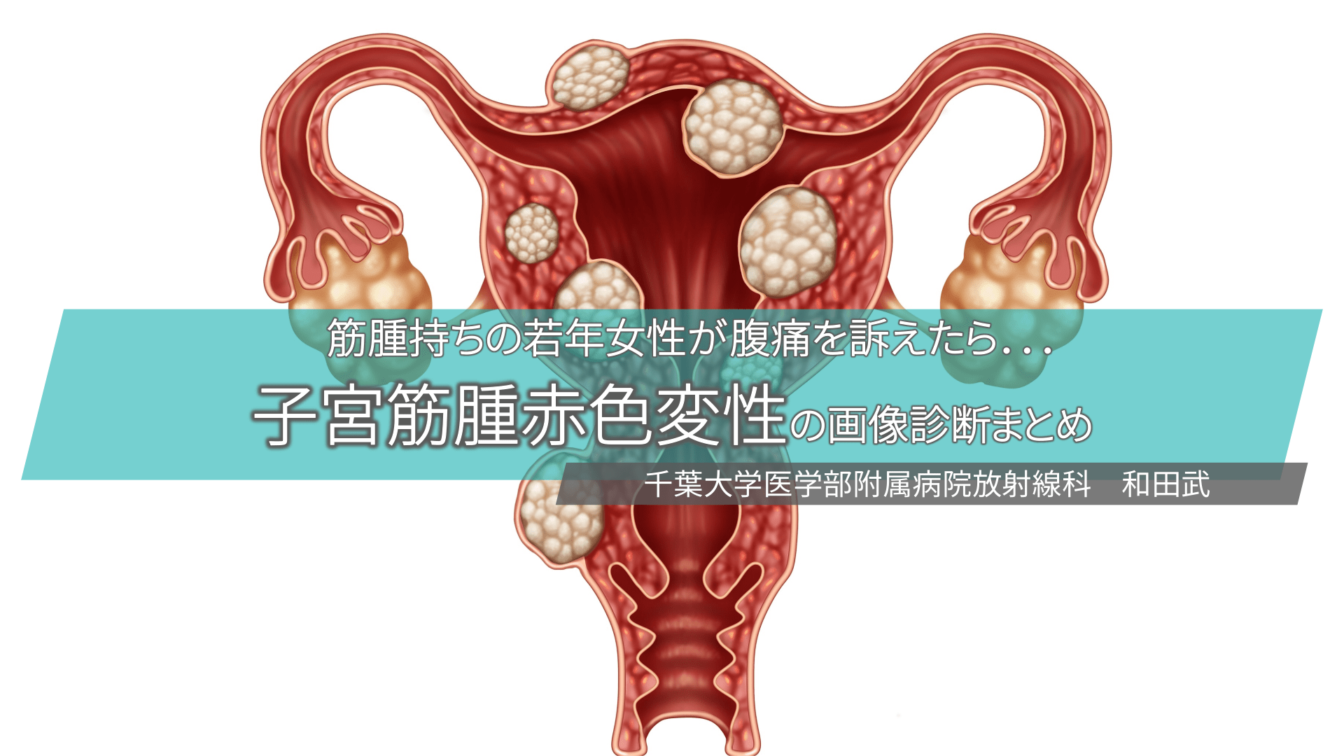 筋腫持ちの若年女性が腹痛を訴えたら．．．子宮筋腫赤色変性の画像診断まとめ L1.png