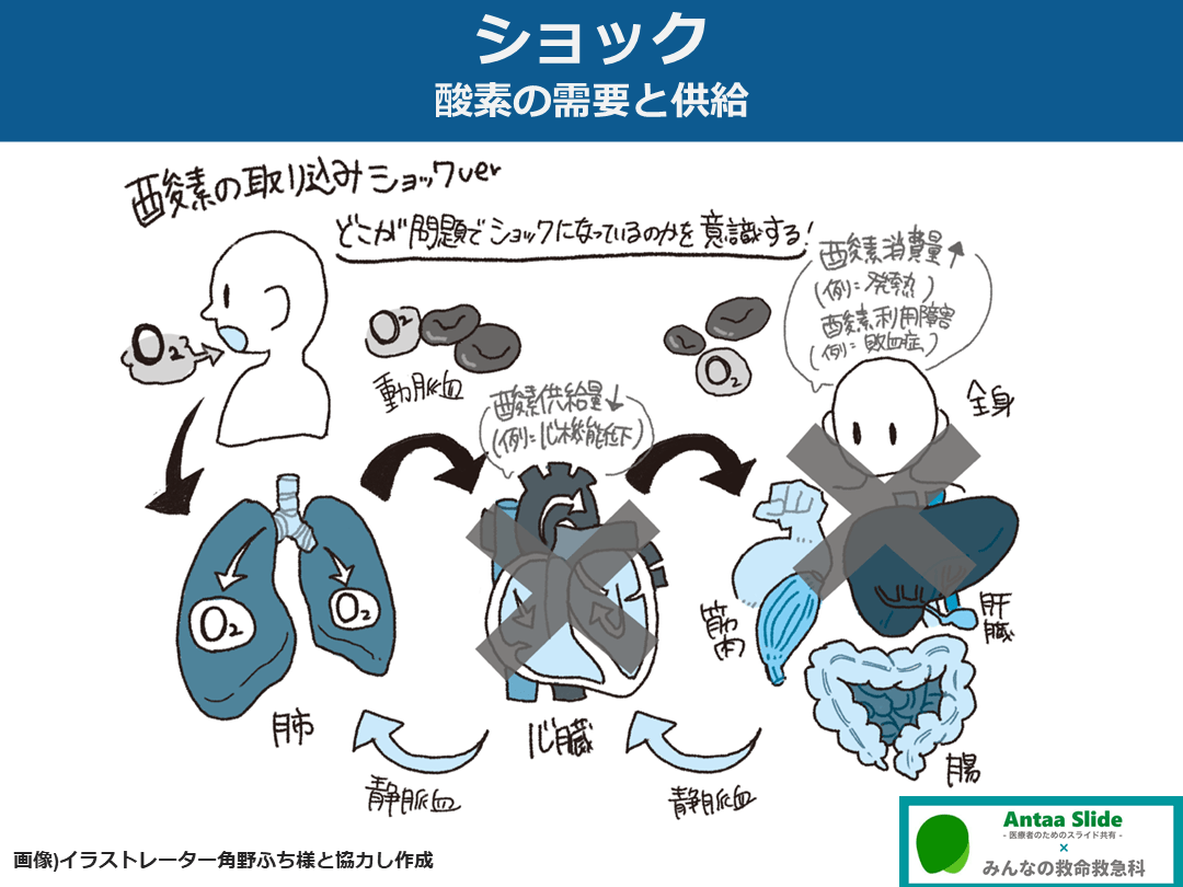 ショックのまとめ【定義・分類・鑑別を中心に】 | Antaa Slide