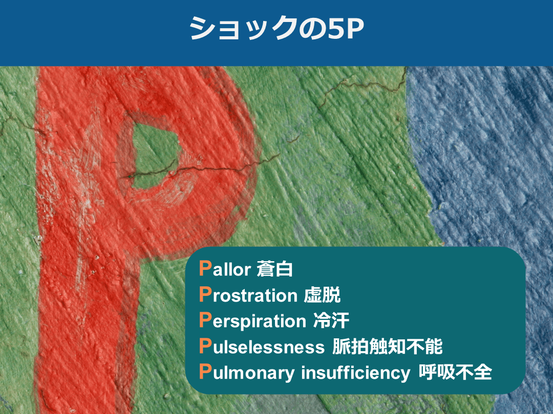 ショックのまとめ【定義・分類・鑑別を中心に】 | Antaa Slide