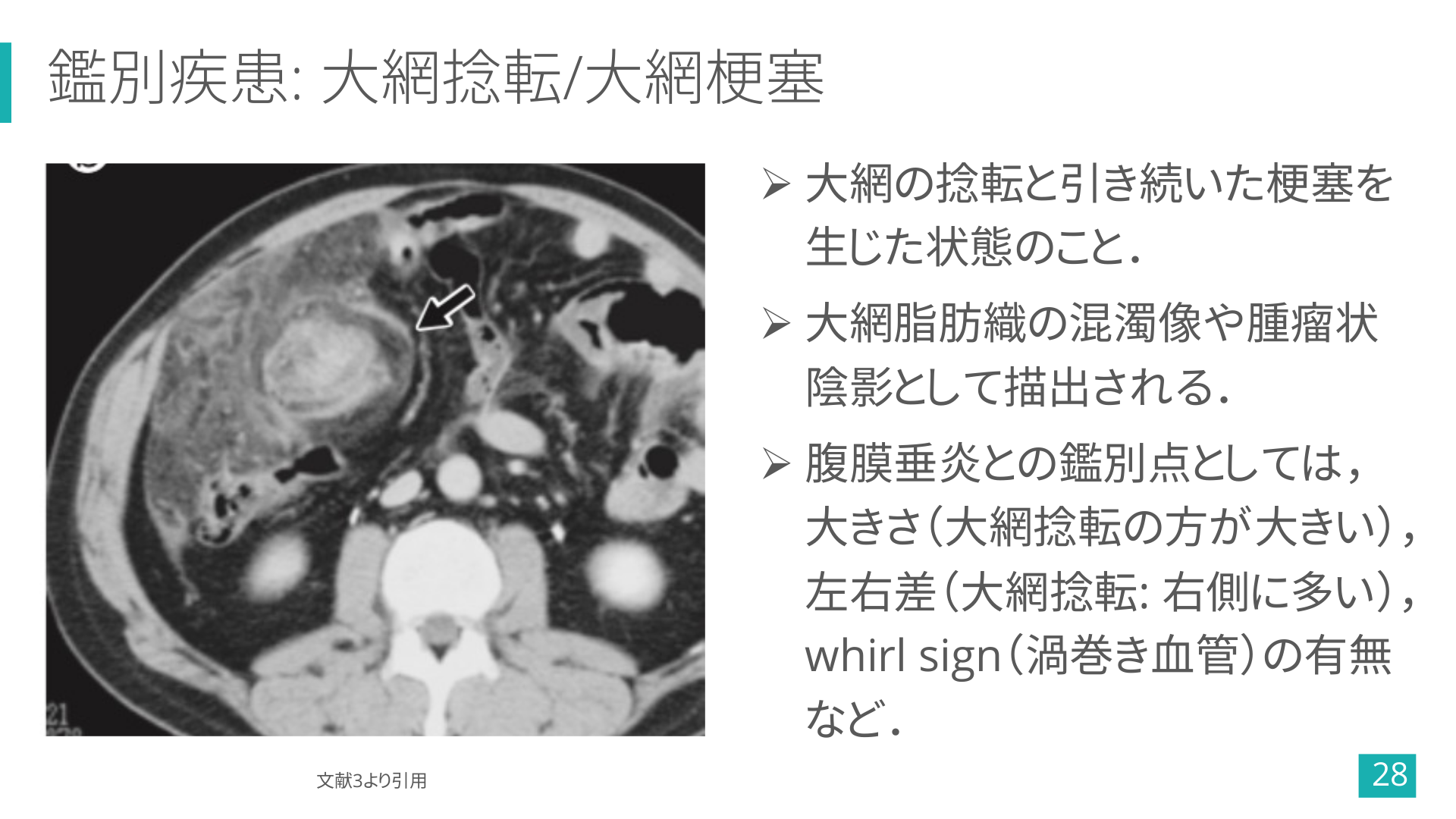 憩室炎だけじゃない! 結腸周囲の脂肪織濃度上昇と言えばコレ! 腹膜垂炎の画像診断まとめ | Antaa Slide