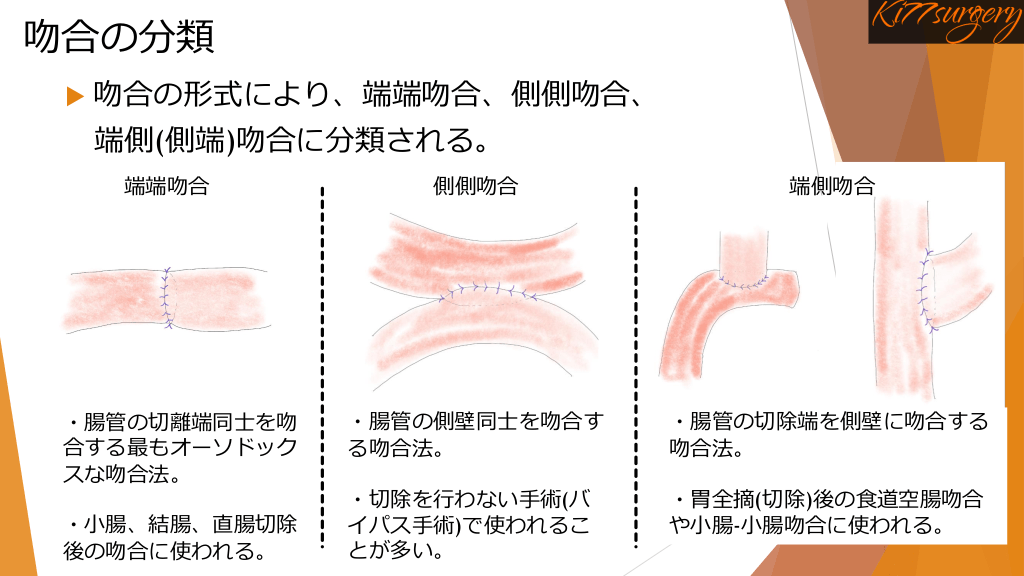 取って終わりじゃない！！消化器外科医の再建手技 | Antaa Slide