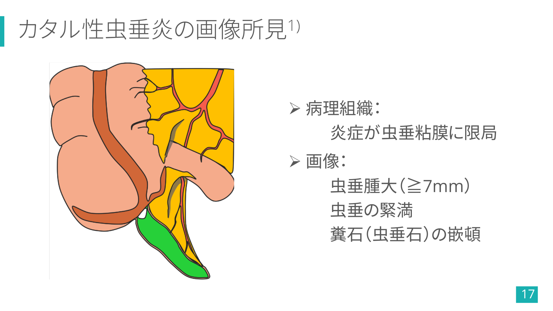 虫垂炎の危険性は何ですか?