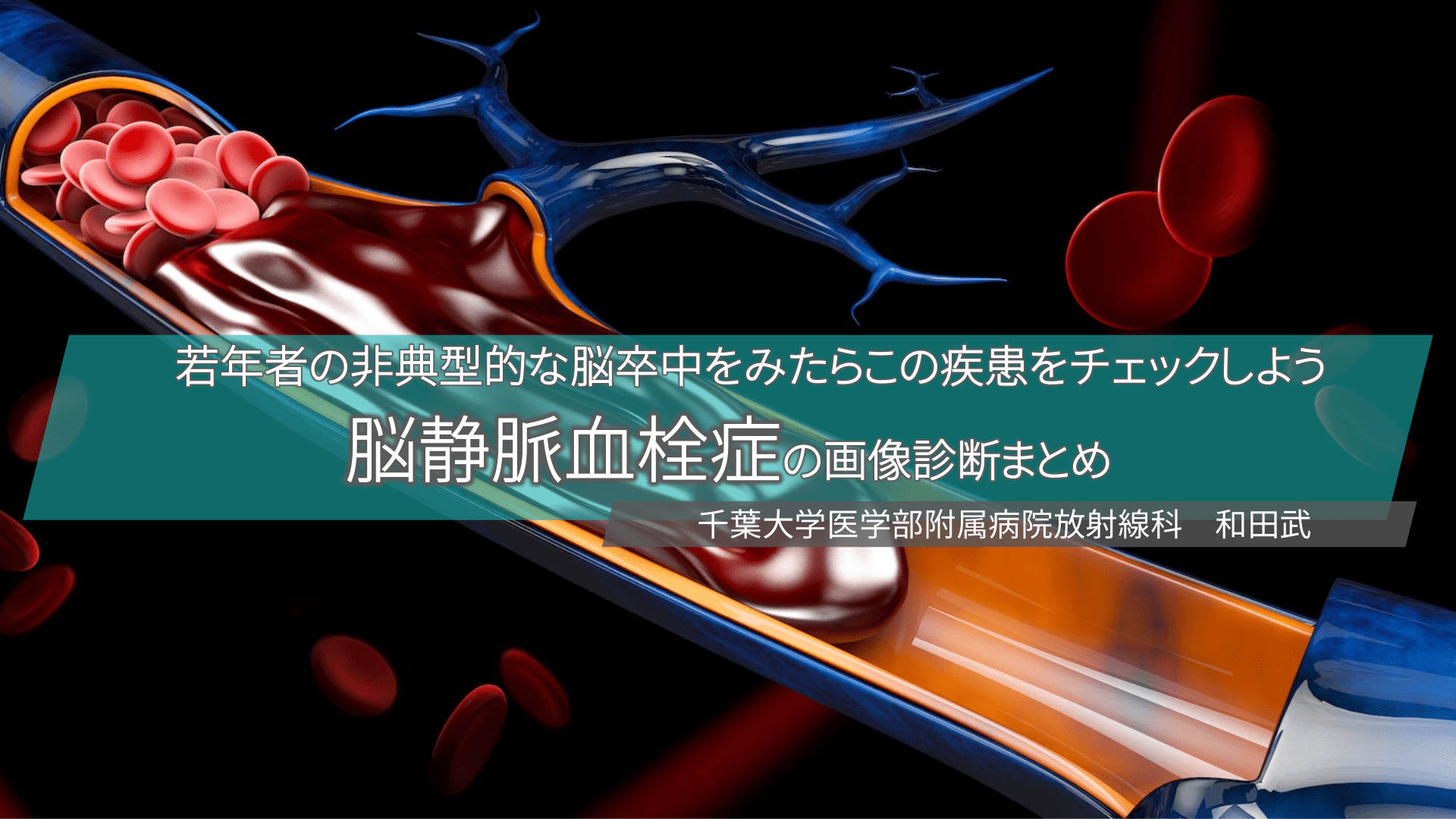 脳静脈洞血栓症予後, 脳静脈洞血栓症 画像診断 – SJGZY