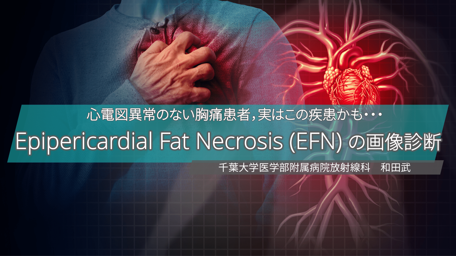 心電図異常のない胸痛患者 実はこの疾患かも Epipericardial Fat Necrosis Efn の画像診断 Antaa Slide 心電図異常のない胸痛患者 実はこの疾患かも Epipericardial Fat Necrosis Efn の画像診断 Antaa Slide