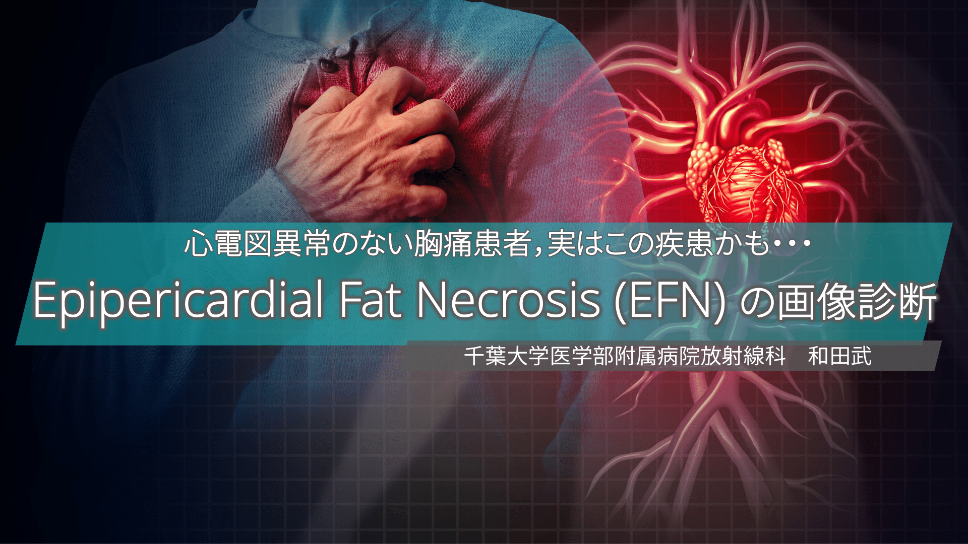 心電図異常のない胸痛患者，実はこの疾患かも・・・ Epipericardial Fat Necrosis (EFN) の画像診断 L1.png