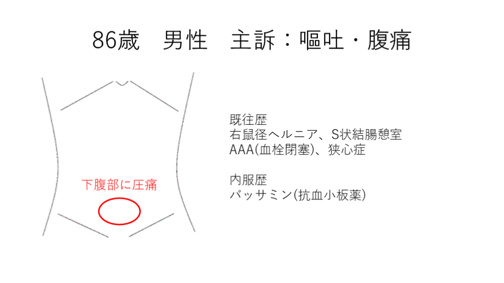 腹部救急疾患の画像診断とインターベンション - その他